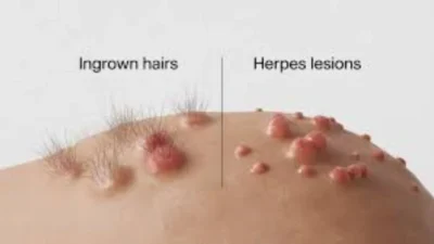 ingrown hair vs herpes